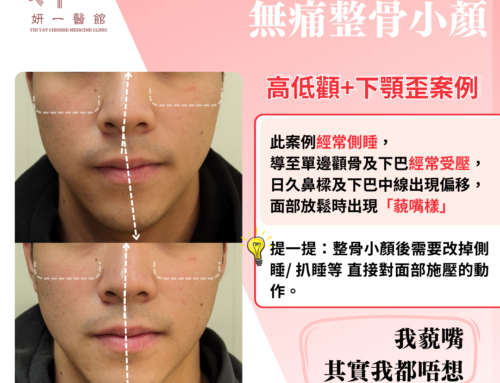 面對問題- 高低顴+下顎歪