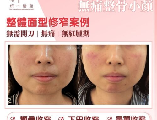 面對問題- 腮骨外擴