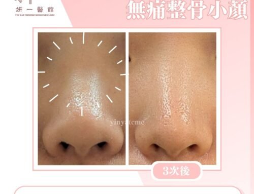 面對問題- 鼻骨調整